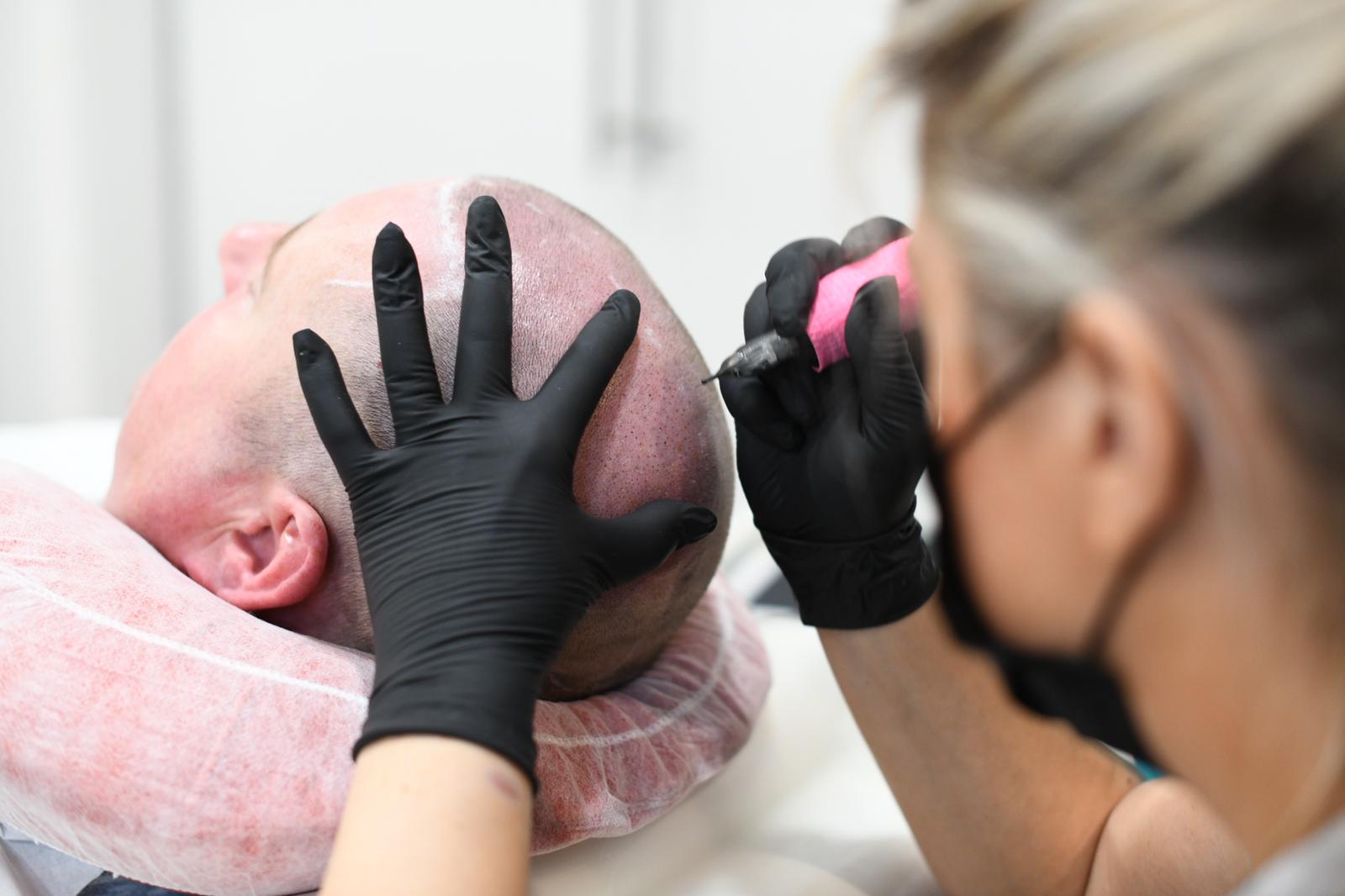 Scalp Micropigmentation 