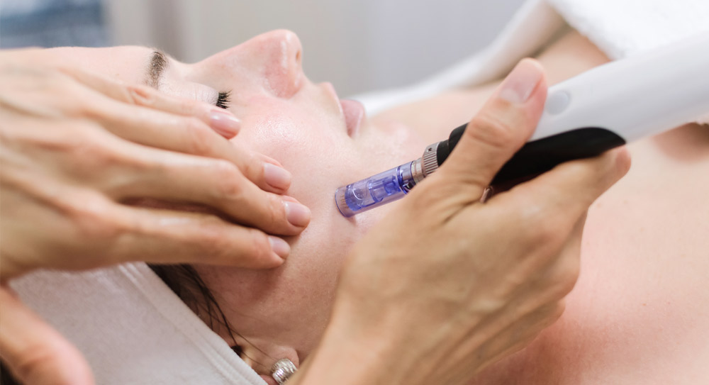 Cosmetic- Skin Needling 